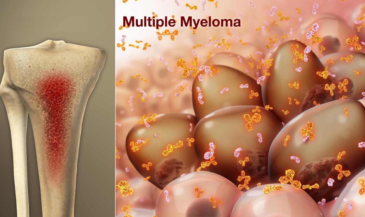 Multiple-Myeloma.jpg