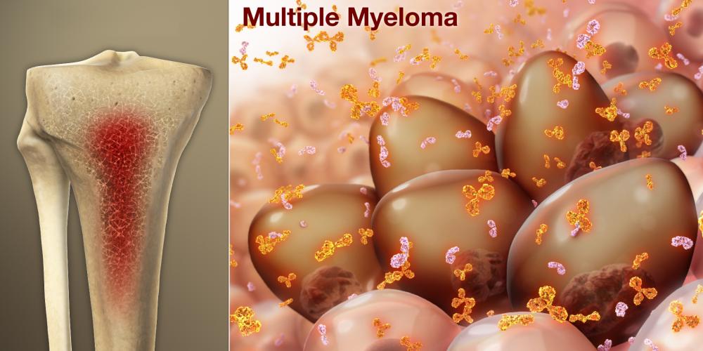 Multiple-Myeloma.jpg